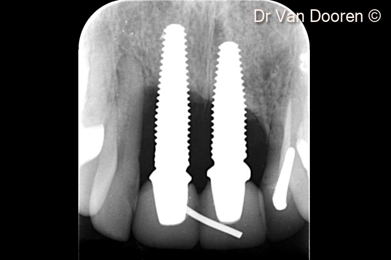 Bệnh nhân có biểu hiện viêm quanh implant nặng ở 2 implant zirconia vùng răng cửa trung tâm