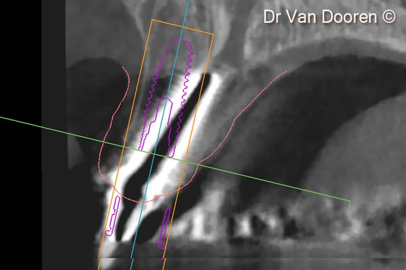 Việc chồng ghép tệp STL và tệp Dicom trong phần mềm lập kế hoạch (MSoft/MIS) cho phép chúng tôi lập kế hoạch vị trí chính xác của thiết bị cấy ghép mới.