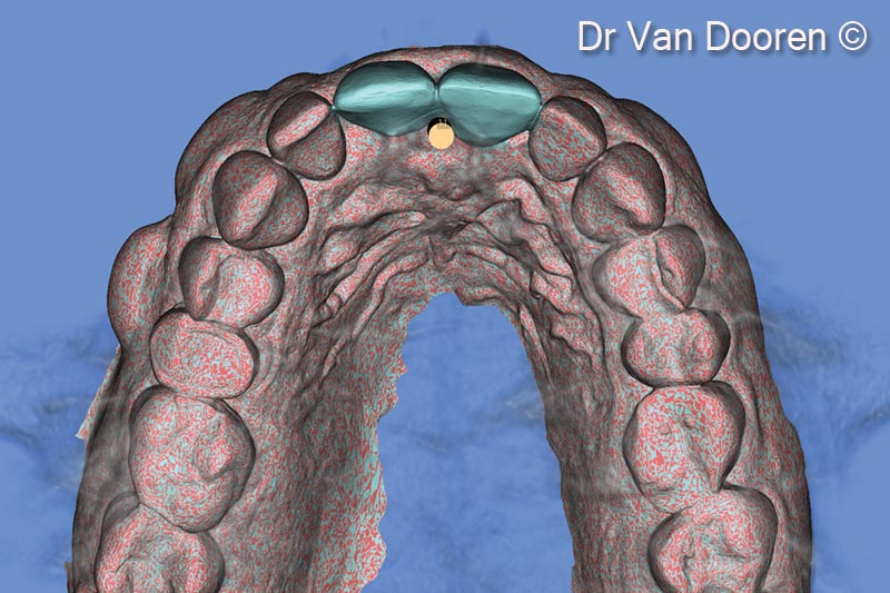 Việc chồng ghép tệp STL và tệp Dicom trong phần mềm lập kế hoạch (MSoft/MIS) cho phép chúng tôi lập kế hoạch vị trí chính xác của thiết bị cấy ghép mới.