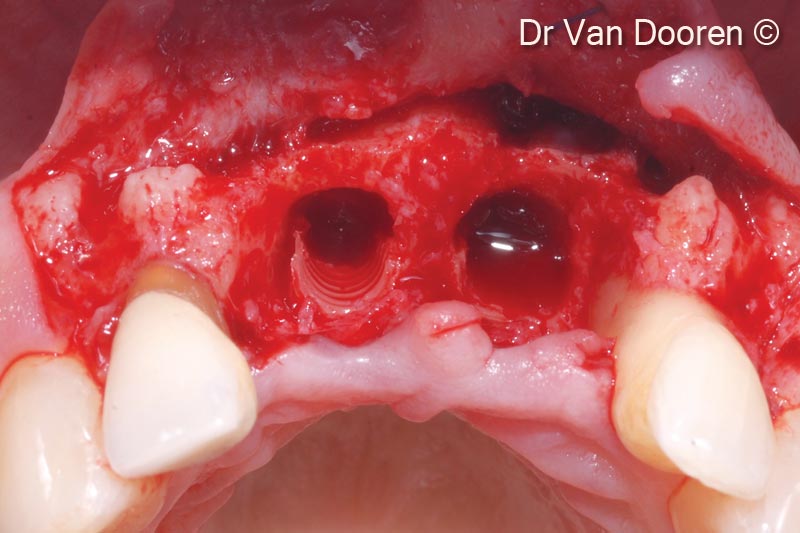 Tình trạng tiêu xương đáng kể xung quanh các implant hiện có và phía gần răng cửa bên: hai implant đã được tháo bỏ