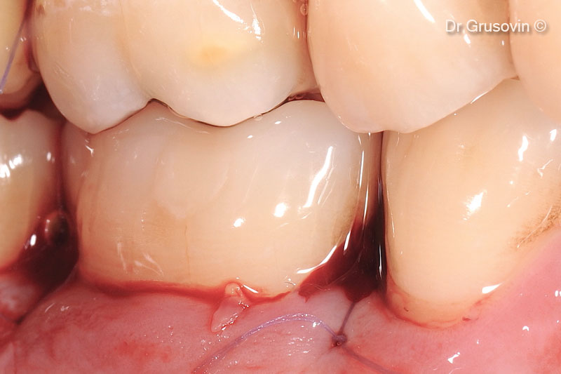 Tình hình lâm sàng sau 7 năm theo dõi.