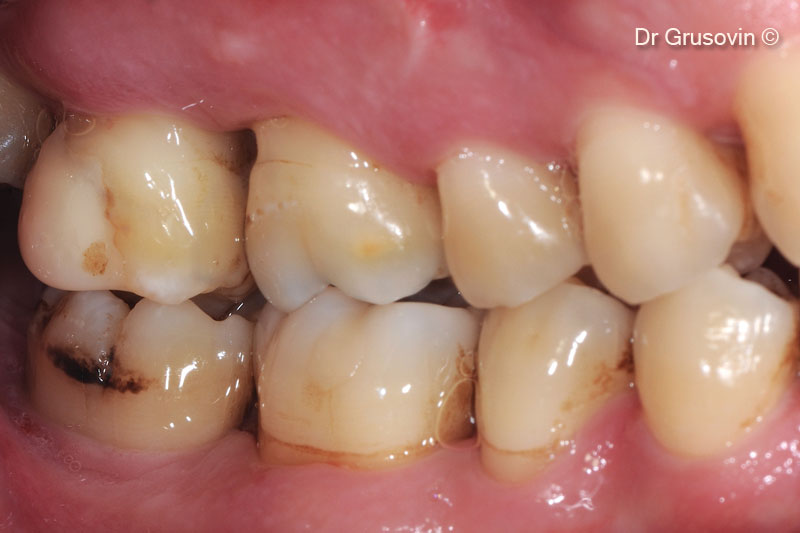 Tình hình lâm sàng sau 7 năm theo dõi.