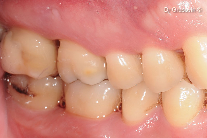 Tăng số 16 quan trọng, tổn thương vùng chẻ nhánh III, vùng tiền đình xa