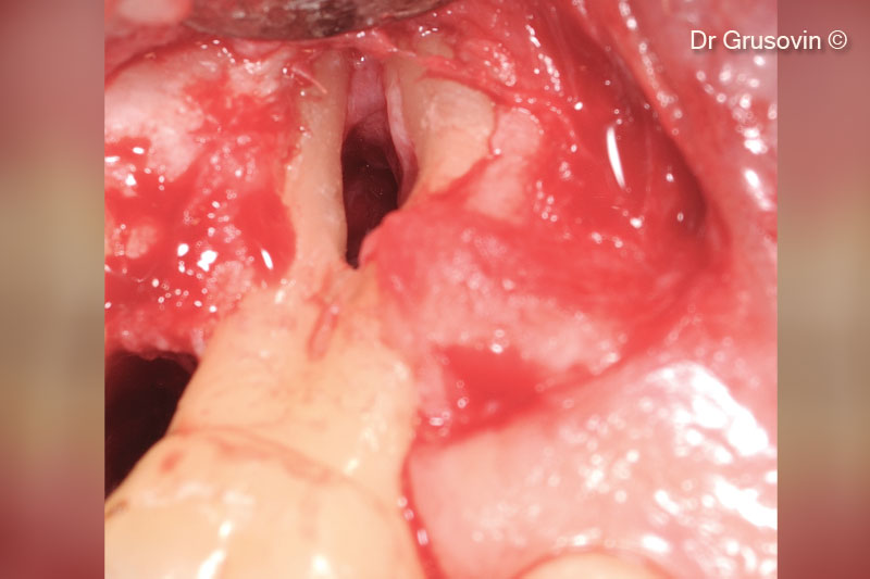 Quan sát lâm sàng trong quá trình phẫu thuật: tổn thương vùng tiền đình và nhánh chẻ III xa.