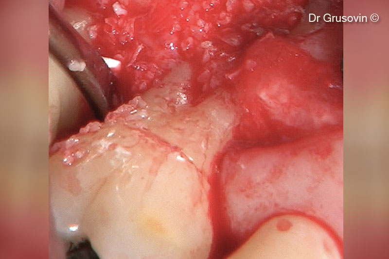 OsteoBiol® Gen-Os® được cấy ghép vào tiền đình.