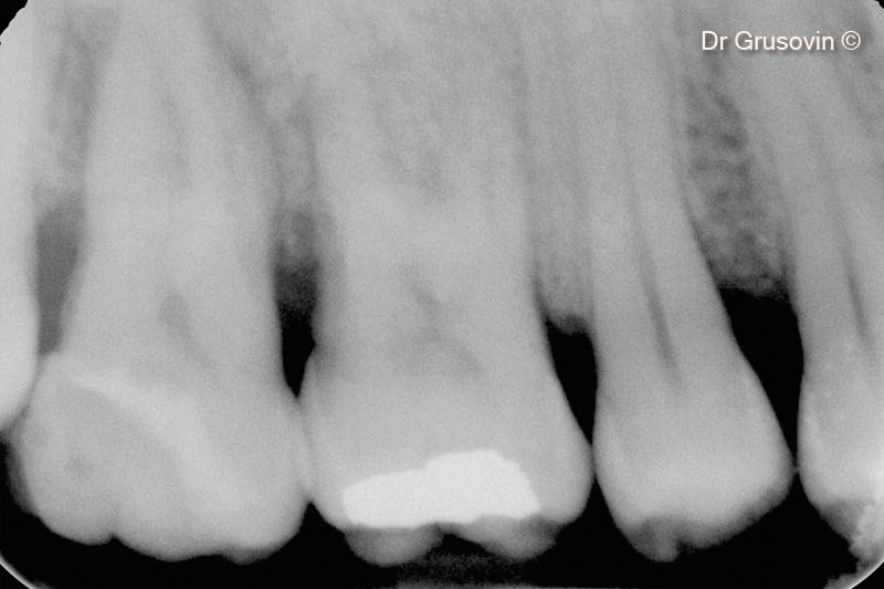 Chụp X-quang sau 1 năm theo dõi.