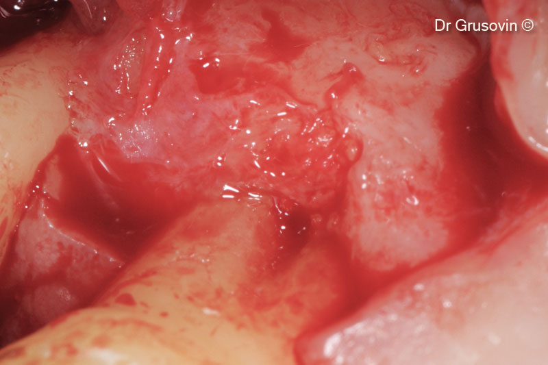 Sự hình thành xương ở khuyết tật chẽ chân răng số 16 sau 1 năm theo dõi.